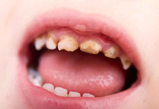 baby bad teeth